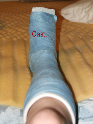 foot cast air
